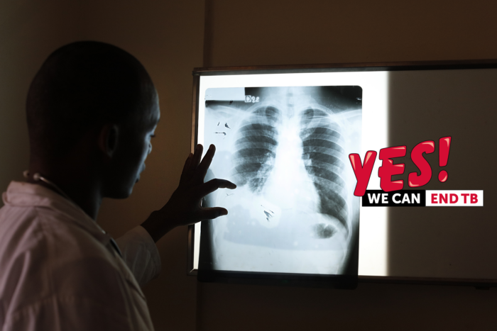 Tuberculose herovert terrein van COVID als meest dodelijke infectieziekte